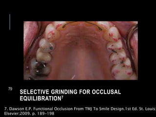 SELECTIVE GRINDING FOR OCCLUSAL
EQUILIBRATION7
79
7. Dawson E.P. Functional Occlusion From TMJ To Smile Design.1st Ed. St. Louis:
Elsevier;2009. p. 189-198
 