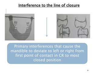 Interference to the line of closure
84
Primary interferences that cause the
mandible to deviate to left or right from
first point of contact in CR to most
closed position
 