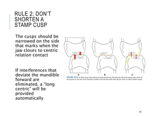 RULE 2: DON’T
SHORTEN A
STAMP CUSP
The cusps should be
narrowed on the side
that marks when the
jaw closes to centric
relation contact
If interferences that
deviate the mandible
forward are
eliminated, a “long
centric” will be
provided
automatically
88
 