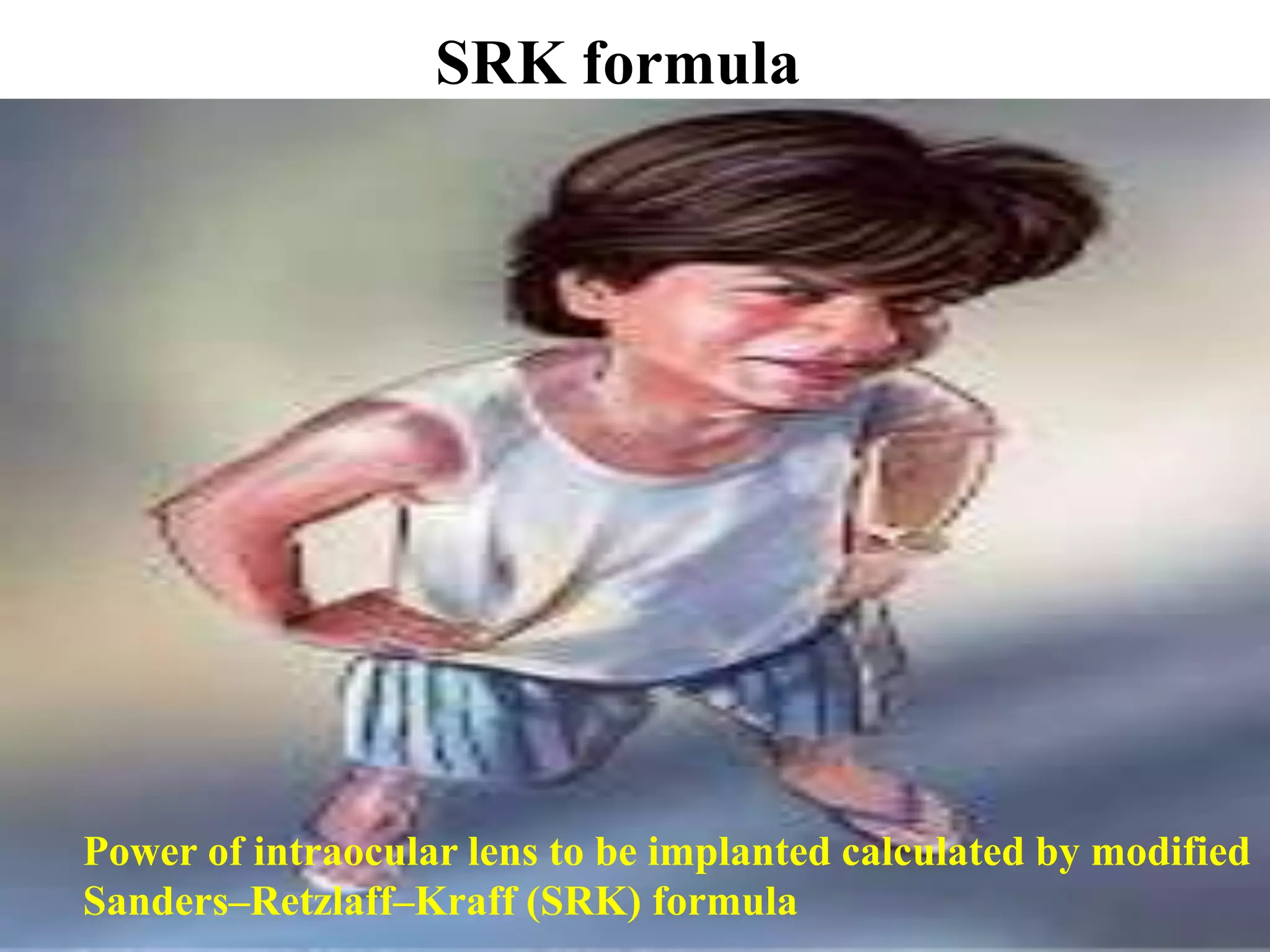 SRK formula
Power of intraocular lens to be implanted calculated by modified
Sanders–Retzlaff–Kraff (SRK) formula
 