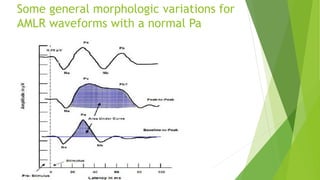 Some general morphologic variations for
AMLR waveforms with a normal Pa
 