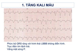 10. ECG RỐI LOẠN ĐIỆN GIẢI.ppt