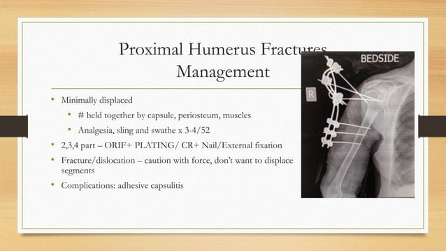 Humerus Fractures | PPT