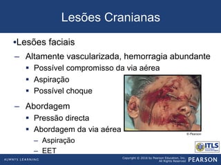 Copyright © 2016 by Pearson Education, Inc.
All Rights Reserved
Lesões Cranianas
• Lesões faciais
–  Altamente vascularizada, hemorragia abundante
§  Possível compromisso da via aérea
§  Aspiração
§  Possível choque
–  Abordagem
§  Pressão directa
§  Abordagem da via aérea
–  Aspiração
–  EET
© Pearson
 