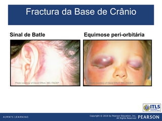 Copyright © 2016 by Pearson Education, Inc.
All Rights Reserved
Fractura da Base de Crânio
Sinal de Batle Equimose peri-orbitária
Photo courtesy of David Effron, MD, FACEP Photo courtesy of David Effron, MD, FACEP
 