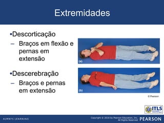 Copyright © 2016 by Pearson Education, Inc.
All Rights Reserved
Extremidades
• Descorticação
–  Braços em flexão e
pernas em
extensão
• Descerebração
–  Braços e pernas
em extensão
© Pearson
 