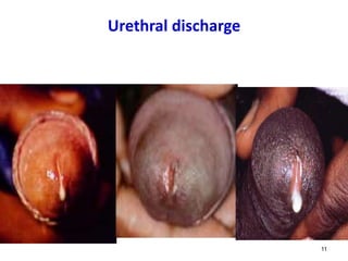 Urethral discharge
11
 