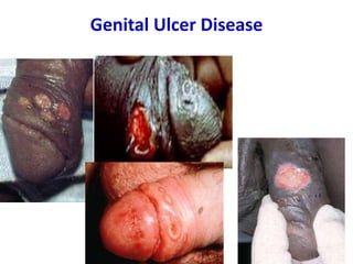 Genital Ulcer Disease
18
 