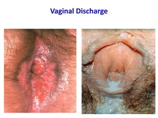 Vaginal Discharge
23
 