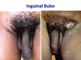 Inguinal Bubo
35
 