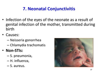 7. Neonatal Conjunctivitis
• Infection of the eyes of the neonate as a result of
genital infection of the mother, transmitted during
birth
• Causes:
– Neisseria gonorrhea
– Chlamydia trachomatis
• Non-STIs:
– S. pneumonia,
– H. influenza,
– S. aureus.
37
 