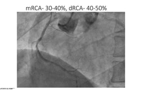 mRCA- 30-40%, dRCA- 40-50%
 