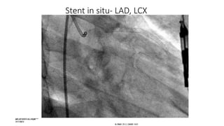 Stent in situ- LAD, LCX
 