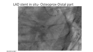 LAD stent in situ- Osteoprox-Distal part
 