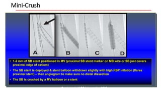 Mini-Crush
• 1-2 mm of SB stent positioned in MV (proximal SB stent marker on MB wire or SB just covers
proximal edge of ostium)
• The SB stent is deployed & stent balloon withdrawn slightly with high RBP inflation (flares
proximal stent) – then angiogram to make sure no distal dissection
• The SB is crushed by a MV balloon or a stent
Ormiston J, JACC Intervention 2008
 