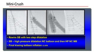 Mini-Crush
• Rewire SB with two step dilatation
• SB – high pressure dilatation NC balloon and then HP NC MB
• Final kissing balloon inflation 12 ATM
Ormiston J, JACC Intervention 2008
 
