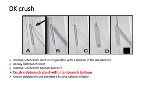 DK crush
 Position sidebranch stent in conjunction with a balloon in the mainbranch
 Deploy sidebranch stent
 Remove sidebranch balloon and wire
Crush sidebranch stent with mainbranch balloon
 Rewire sidebranch and perform a kissing balloon inflation
 
