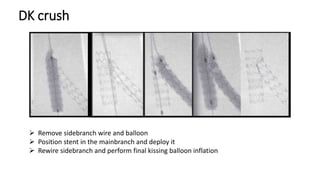 DK crush
 Remove sidebranch wire and balloon
 Position stent in the mainbranch and deploy it
 Rewire sidebranch and perform final kissing balloon inflation
 
