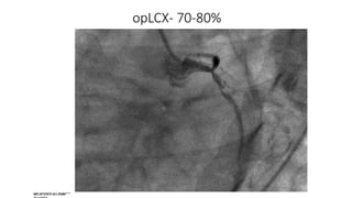 opLCX- 70-80%
 