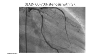 dLAD- 60-70% stenosis with ISR
 