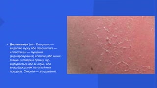 • Десквамація (лат. Desquamo —
видаляю луску або desquamare —
«пластівці») — лущення
(відшаровування) епітелію або інших
тканин з поверхні органу, що
відбувається або в нормі, або
внаслідок різних патологічних
процесів. Синонім — злущування.
 