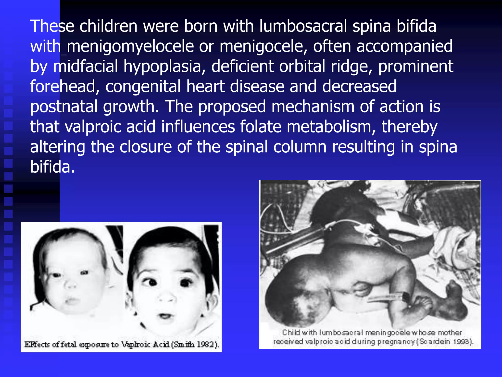 These children were born with lumbosacral spina bifida
with menigomyelocele or menigocele, often accompanied
by midfacial hypoplasia, deficient orbital ridge, prominent
forehead, congenital heart disease and decreased
postnatal growth. The proposed mechanism of action is
that valproic acid influences folate metabolism, thereby
altering the closure of the spinal column resulting in spina
bifida.
 