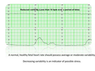 Variability Labor 10.Antenatal Assesment of fetal well being (10).pptx