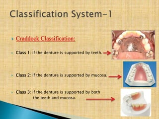  Craddock Classification:
 Class 1: if the denture is supported by teeth.
 Class 2: if the denture is supported by mucosa.
 Class 3: if the denture is supported by both
the teeth and mucosa.
 