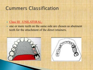  Class III –UNILATERAL:
 one or more teeth on the same side are chosen as abutment
teeth for the attachment of the direct retainers.

 