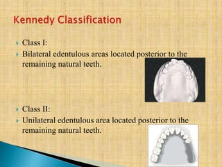 Class I:
 Bilateral edentulous areas located posterior to the
remaining natural teeth.
 Class II:
 Unilateral edentulous area located posterior to the
remaining natural teeth.
 