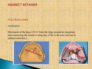 FULCRUM LINES
•Definition:
Movement of the base AWAY from the ridge around an imaginary
line connecting the retentive clasp tips. (This is the axis relevant to
indirect retention.)
 