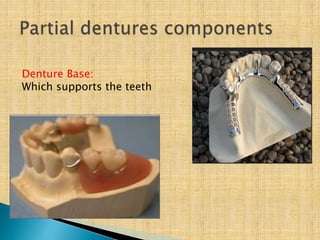 Denture Base:
Which supports the teeth
 