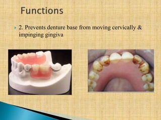  2. Prevents denture base from moving cervically &
impinging gingiva
 