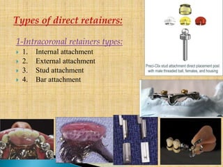 1-Intracoronal retainers types:
 1. Internal attachment
 2. External attachment
 3. Stud attachment
 4. Bar attachment
 