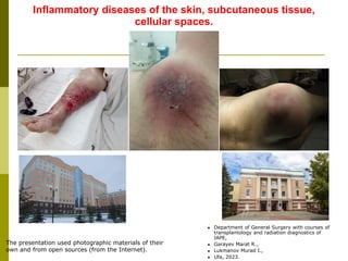 Inflammatory diseases of the skin, subcutaneous tissue,
cellular spaces.
The presentation used photographic materials of their
own and from open sources (from the Internet).
 Department of General Surgery with courses of
transplantology and radiation diagnostics of
IAPE,
 Garayev Marat R.,
 Lukmanov Murad I.,
 Ufa, 2023.
 