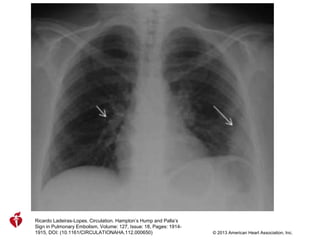 Ricardo Ladeiras-Lopes. Circulation. Hampton’s Hump and Palla’s
Sign in Pulmonary Embolism, Volume: 127, Issue: 18, Pages: 1914-
1915, DOI: (10.1161/CIRCULATIONAHA.112.000650) © 2013 American Heart Association, Inc.
 