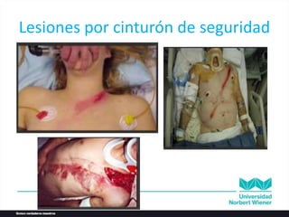 Lesiones por cinturón de seguridad
 
