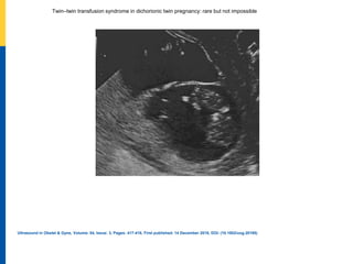 Twin–twin transfusion syndrome in dichorionic twin pregnancy: rare but not impossible
Ultrasound in Obstet & Gyne, Volume: 54, Issue: 3, Pages: 417-418, First published: 14 December 2018, DOI: (10.1002/uog.20195)
 