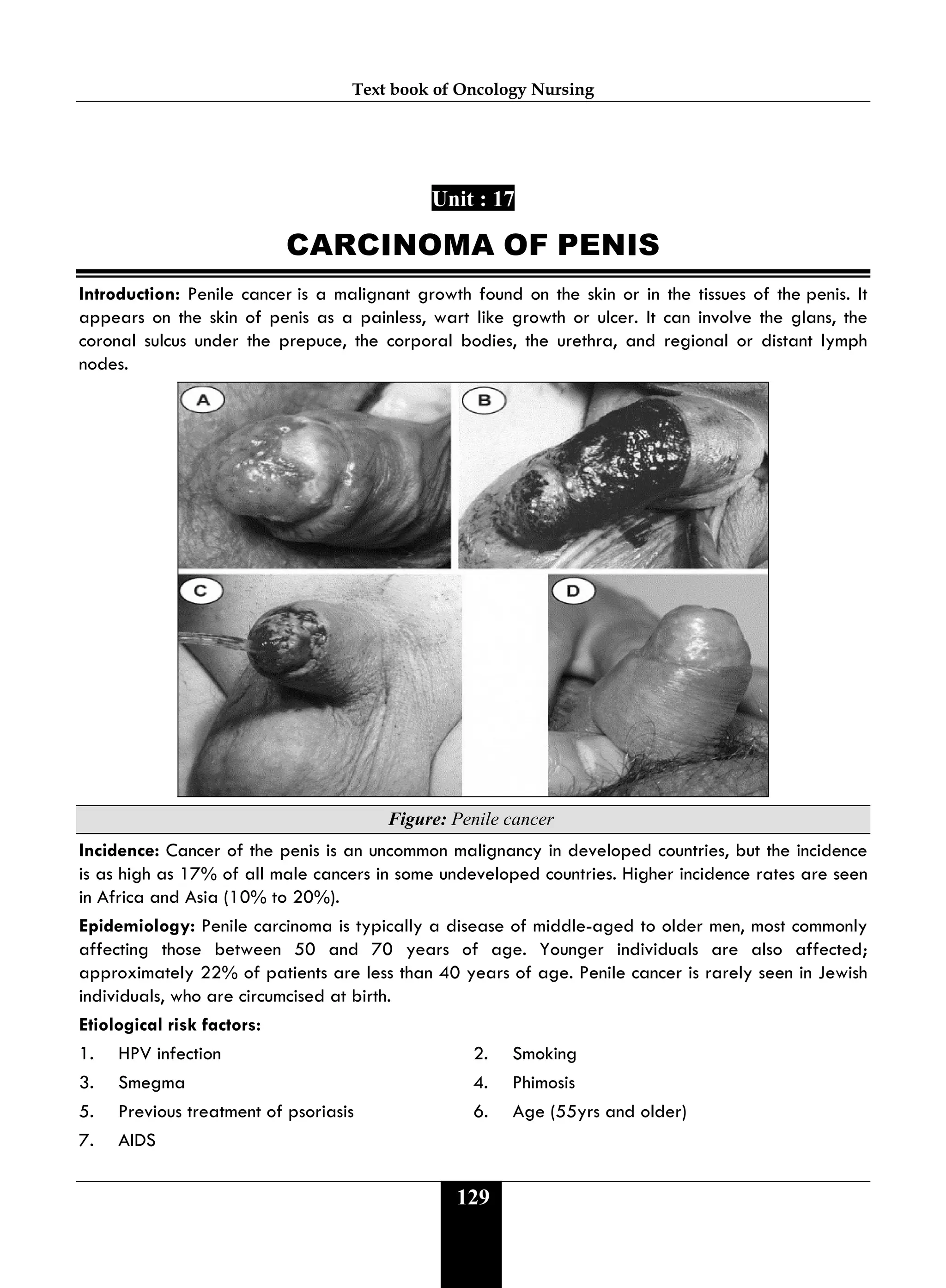 Text book of Oncology Nursing
129
Unit : 17
CARCINOMA OF PENIS
Introduction: Penile cancer is a malignant growth found on the skin or in the tissues of the penis. It
appears on the skin of penis as a painless, wart like growth or ulcer. It can involve the glans, the
coronal sulcus under the prepuce, the corporal bodies, the urethra, and regional or distant lymph
nodes.
Figure: Penile cancer
Incidence: Cancer of the penis is an uncommon malignancy in developed countries, but the incidence
is as high as 17% of all male cancers in some undeveloped countries. Higher incidence rates are seen
in Africa and Asia (10% to 20%).
Epidemiology: Penile carcinoma is typically a disease of middle-aged to older men, most commonly
affecting those between 50 and 70 years of age. Younger individuals are also affected;
approximately 22% of patients are less than 40 years of age. Penile cancer is rarely seen in Jewish
individuals, who are circumcised at birth.
Etiological risk factors:
1. HPV infection 2. Smoking
3. Smegma 4. Phimosis
5. Previous treatment of psoriasis 6. Age (55yrs and older)
7. AIDS
 