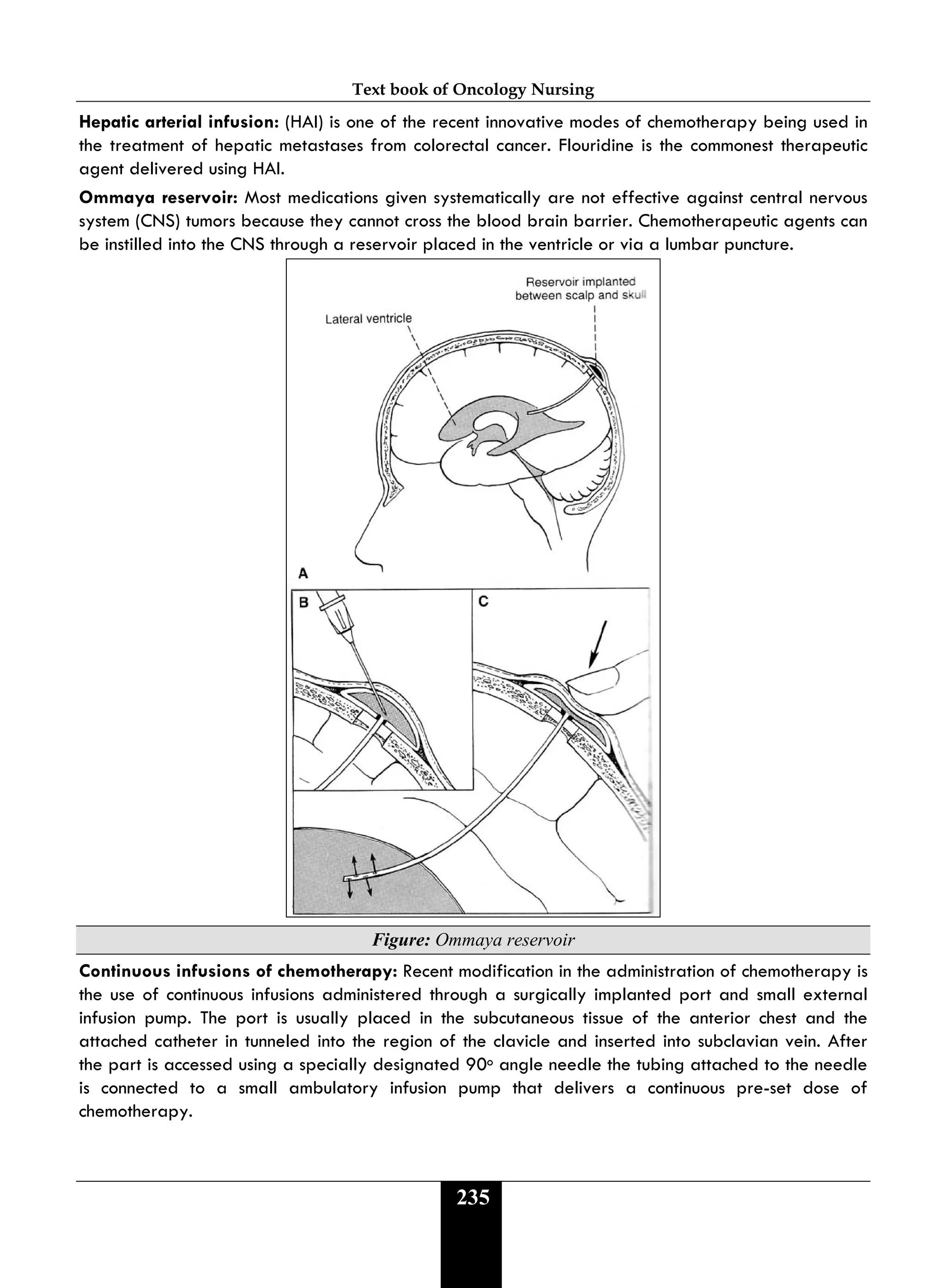 Text book of Oncology Nursing
235
Hepatic arterial infusion: (HAI) is one of the recent innovative modes of chemotherapy being used in
the treatment of hepatic metastases from colorectal cancer. Flouridine is the commonest therapeutic
agent delivered using HAI.
Ommaya reservoir: Most medications given systematically are not effective against central nervous
system (CNS) tumors because they cannot cross the blood brain barrier. Chemotherapeutic agents can
be instilled into the CNS through a reservoir placed in the ventricle or via a lumbar puncture.
Figure: Ommaya reservoir
Continuous infusions of chemotherapy: Recent modification in the administration of chemotherapy is
the use of continuous infusions administered through a surgically implanted port and small external
infusion pump. The port is usually placed in the subcutaneous tissue of the anterior chest and the
attached catheter in tunneled into the region of the clavicle and inserted into subclavian vein. After
the part is accessed using a specially designated 90o angle needle the tubing attached to the needle
is connected to a small ambulatory infusion pump that delivers a continuous pre-set dose of
chemotherapy.
 