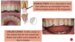 CRAZE LINES: Visible cracks in
the enamel that do not extend into
dentin and either occur naturally or
due to trauma
INFRACTION: It is a descriptive term
that indicates an incomplete fracture
without displacement of the fragments
 
