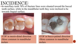 In maxillary teeth 70% of fracture lines were situated toward the buccal
tooth surface, while in the mandibular teeth they were inclined to be
towards lingual surface.
-COF in mesio-distal direction
-More common in mandibular
molars
-COF in bucco-palatal direction
-More common in mandibular
molars
 