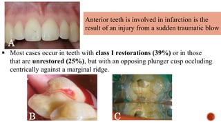 Anterior teeth is involved in infarction is the
result of an injury from a sudden traumatic blow
 Most cases occur in teeth with class I restorations (39%) or in those
that are unrestored (25%), but with an opposing plunger cusp occluding
centrically against a marginal ridge.
A
C
B
 
