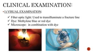 1) VISUAL EXAMINATION:
 Fiber optic light: Used to transilluminate a fracture line
 Dye: Methylene blue or red dye
 Microscope: in combination with dye
 