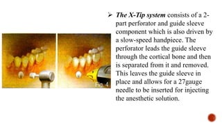  The X-Tip system consists of a 2-
part perforator and guide sleeve
component which is also driven by
a slow-speed handpiece. The
perforator leads the guide sleeve
through the cortical bone and then
is separated from it and removed.
This leaves the guide sleeve in
place and allows for a 27gauge
needle to be inserted for injecting
the anesthetic solution.
 