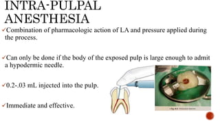 INTRA-PULPAL
ANESTHESIA
Combination of pharmacologic action of LA and pressure applied during
the process.
Can only be done if the body of the exposed pulp is large enough to admit
a hypodermic needle.
0.2-.03 mL injected into the pulp.
Immediate and effective.
 