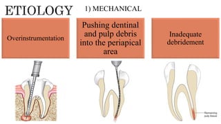 Overinstrumentation
Pushing dentinal
and pulp debris
into the periapical
area
Inadequate
debridement
1) MECHANICAL
 