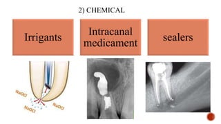 2) CHEMICAL
Irrigants
Intracanal
medicament
sealers
 