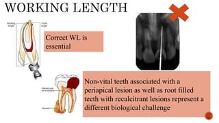 Correct WL is
essential
Non-vital teeth associated with a
periapical lesion as well as root filled
teeth with recalcitrant lesions represent a
different biological challenge
 