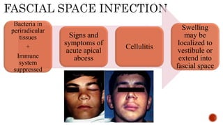 Bacteria in
periradicular
tissues
+
Immune
system
suppressed
Signs and
symptoms of
acute apical
abcess
Cellulitis
Swelling
may be
localized to
vestibule or
extend into
fascial space
 